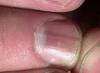 Ямки на ногтях, причины деформации, вочему появляются вмятины и выемки на пальцах От чего вмятины на ногтях