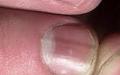 Ямки на ногтях, причины деформации, вочему появляются вмятины и выемки на пальцах От чего вмятины на ногтях
